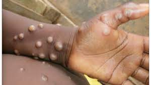 Texas records first case of monkeypox ...