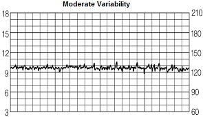 Fetal Heart Rate Variability