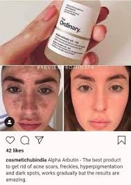 An ingredient with visible brightening effects hyaluronic acid: Aztec Clay Mask Ordinary Alpha Arbutin Serum The Best Facebook