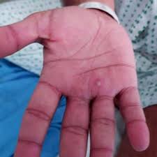 monkeypox rash and scars what does