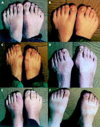 chronic mucocutaneous candidiasis