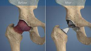 partial hip replacement animation