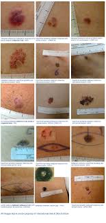 skin cancer international vein skin