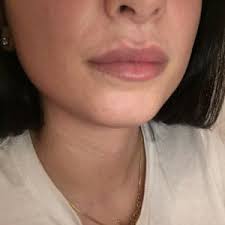 what can i do about my uneven lip line