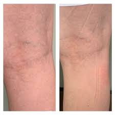 top 10 best varicose vein treatment in