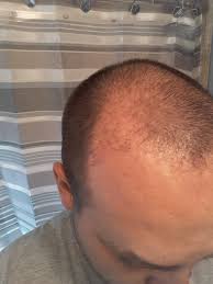 I had a hair transplant fut first procedure 7 months ago (see pics for progress). 7 Months Post Fue Operation My Hair Is Growing In Uneven At This Point Should I Be Concerned Photos