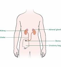 Ileum conduit diversion is still one of the most frequently used urinary diversions. Urostomy Macmillan Cancer Support