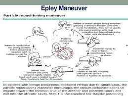 Epley maneuver refers to a sequence of movements conducted on the head to treat benign positional vertigo. Epley Maneuver Instructions Spanish