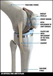 16.07.2020what is the nano kneecomments: Knee Replacement Surgery Treatment Options Versus Arthritis