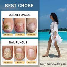 nail fungus best serum repair nail
