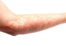 skin rash may point to sars cov 2
