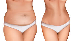 weight can you lose with liposuction