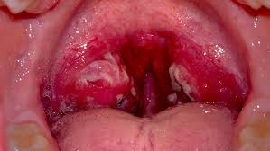 white spots on throat causes and