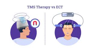 tms therapy vs ect what s the
