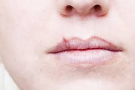 cold sore vs pimple on lip how to