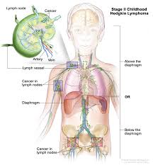 Hodgkin lymphoma can often be cured. Hodgkin Lymphoma University Hospitals