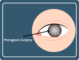 pterygium surgery in hyderabad st