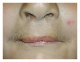 upper lip of the patient at age 3 6 12
