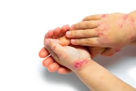 what causes eczema on your hands and