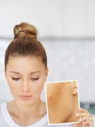 home remes to get rid of dark spots