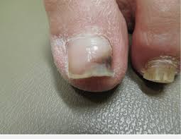 great toenail with improved black