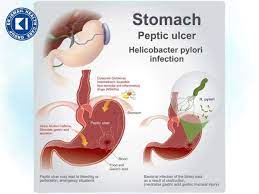 peptic ulcer symptoms causes risks