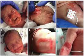 staphylococcal scalded skin syndrome
