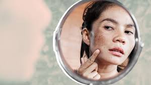 dark spots on face melasma causes