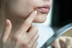lip licker s dermais symptoms