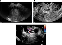 Ultrasound scans use high frequency sound waves to create a picture of. Peritoneal Carcinomatosis In Primary Ovarian Cancer Ultrasound Detection And Comparison With Computed Tomography Ultrasound In Medicine And Biology