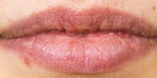 cold sore ses identification and