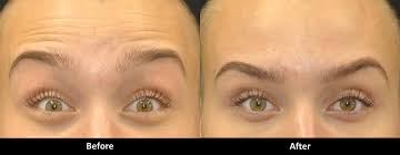 fix heavy eyebrows after botox