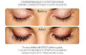 Applying latisse eyelash growth is very similar to. Latisse Eyelash Growth In St Petersburg Fl Dr Kass