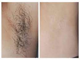 Laser Hair Removal Before After