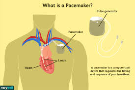 What You Should Know About Pacemakers