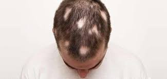of alopecia with causes treatments
