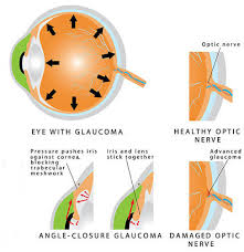 Glaucoma Jacksonville Eye Exam Jacksonville Nc Office