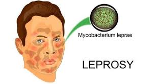 Image result for leprosy