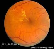 Image result for icd 10 code for dm with nonproliferative retinopathy