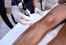 Thinking about laser hair removal? Laser Hair Removal On Olive To Dark Skin With The Lyon Laser Centre