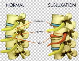 Vertebral Subluxation Chiropractic Vertebral Column Pain
