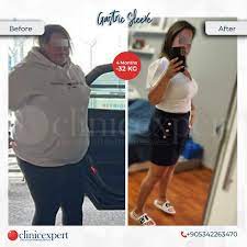 3 months after gastric sleeve
