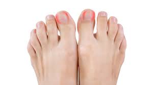 permanent ingrown toe nail treatment