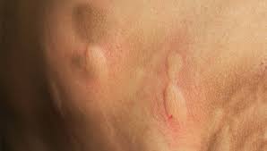 common insect bites and stings