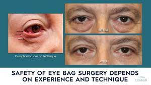 how eye bag removal surgery lower