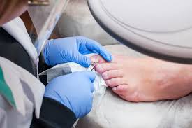 types ses of toenail fungus