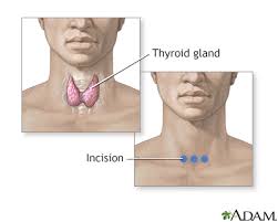 thyroid gland removal information
