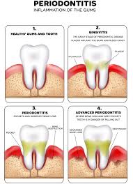 periodontal disease lynbrook smiles