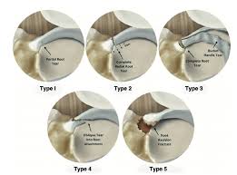 meniscus root tear knee doctor