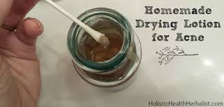 homemade drying lotion for acne
